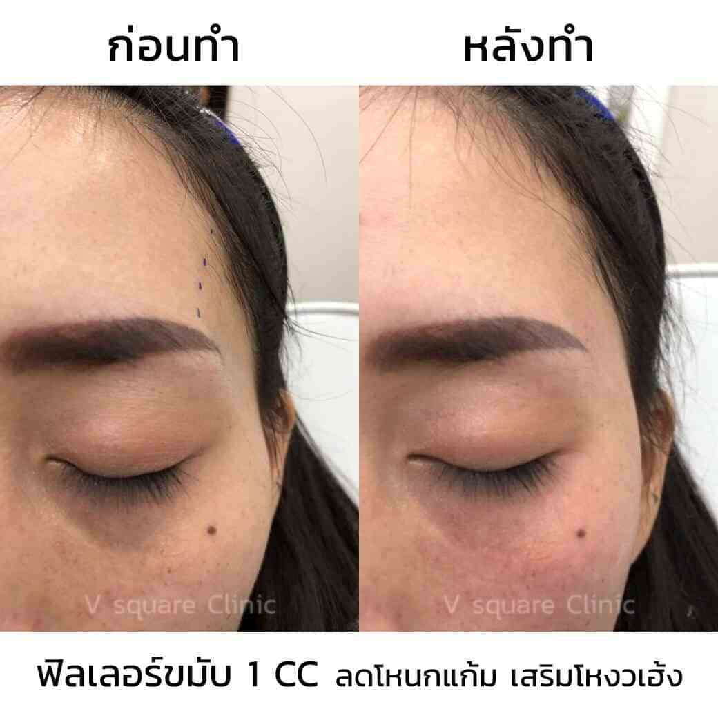 รีวิวฉีดฟิลเลอร์ขมับ1ccลดโหนกแก้มเสริมโหงวเฮง