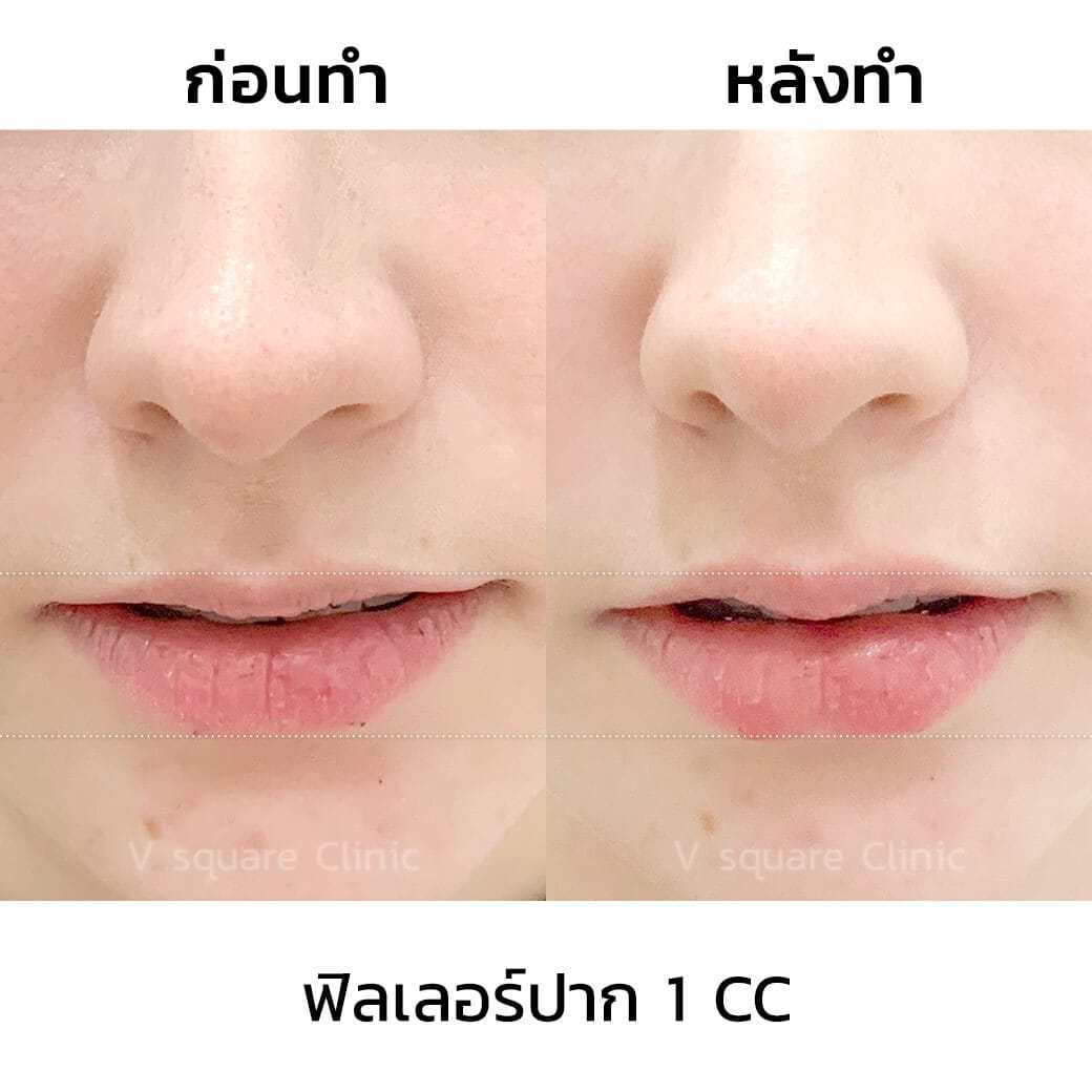 รีวิวเจสซี่ฟิลเลอร์ปาก1cc