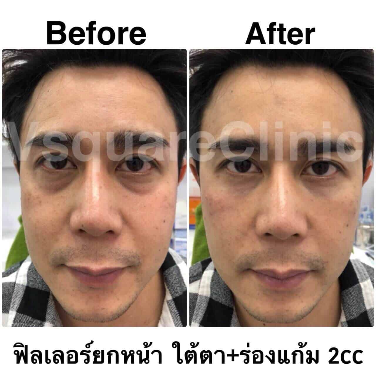 ตัวอย่างรีวิว ผลการรักษาด้วยฟิลเลอร์ยกหน้า ใต้ตา+ร่องแก้ม 2 cc