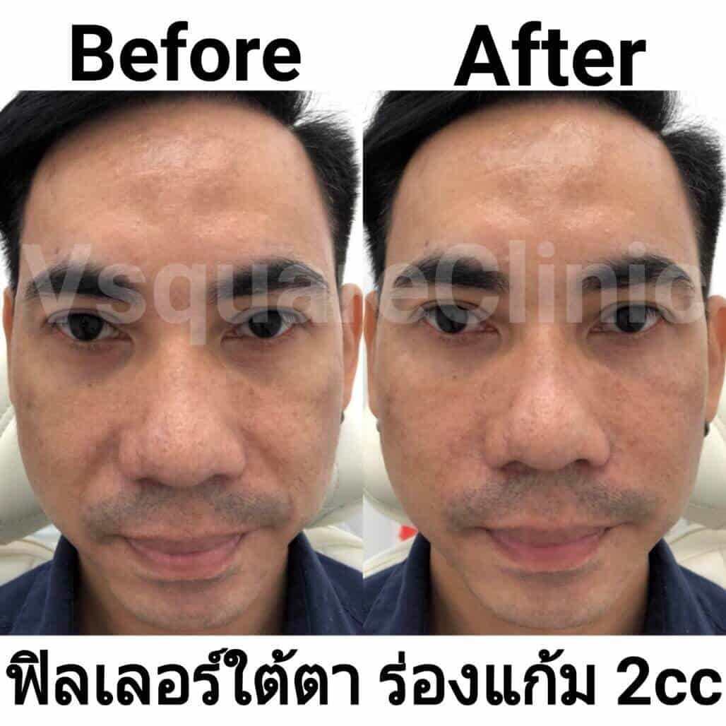 ตัวอย่างรีวิว ผลการรักษาด้วยฟิลเลอร์ ใต้ตา+ร่องแก้ม 2 cc