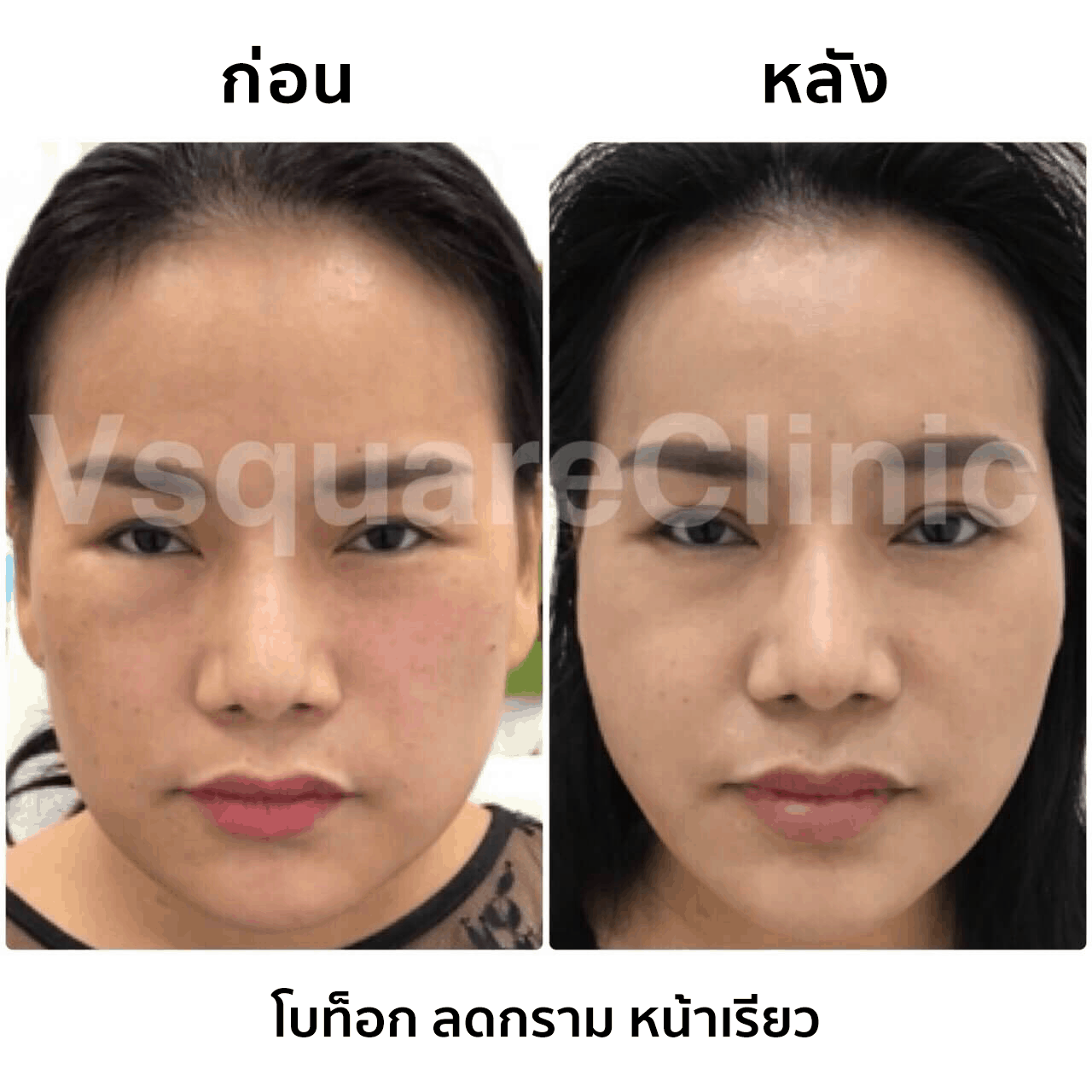 รีวิวโบท็อกลดกราม หน้าเรียว