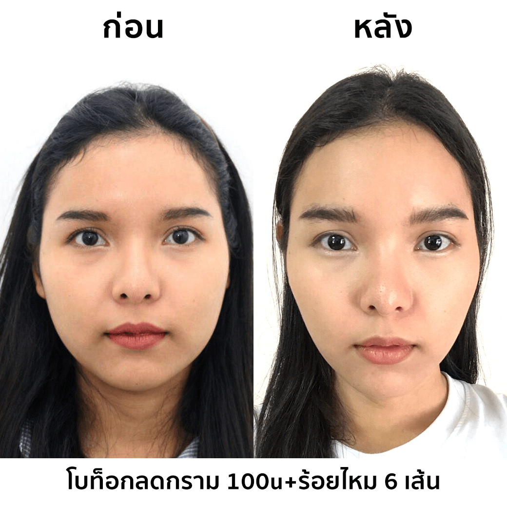 รีวิวโบท็อกลดกราม และร้อยไหม 6 เส้น