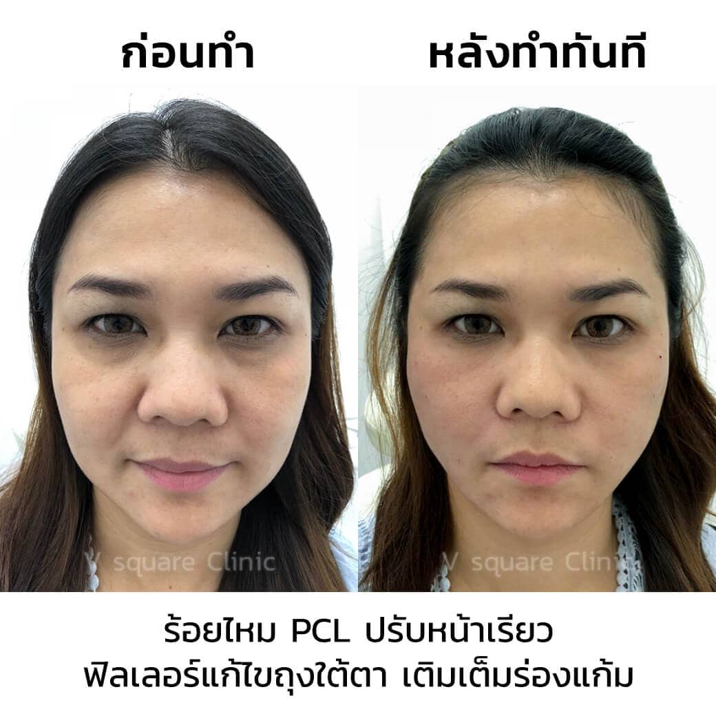 รีวิว ร้อยไหม PCL 4 เส้น+ฟิลเลอร์ใต้ตาร่องแก้ม 2 CC