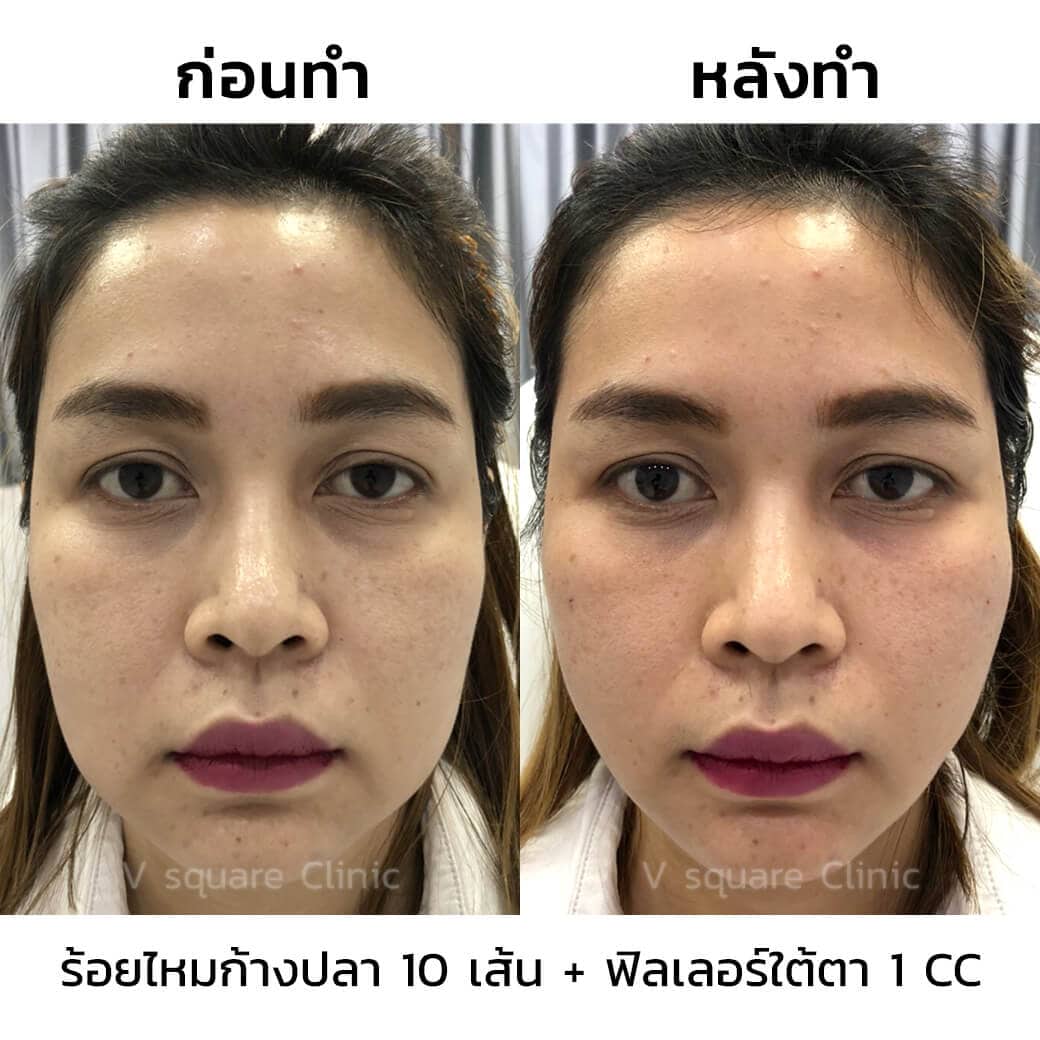 รีวิว ร้อยไหมก้างปลา 10 เส้น+ฟิลเลอร์ใต้ตา 1 CC