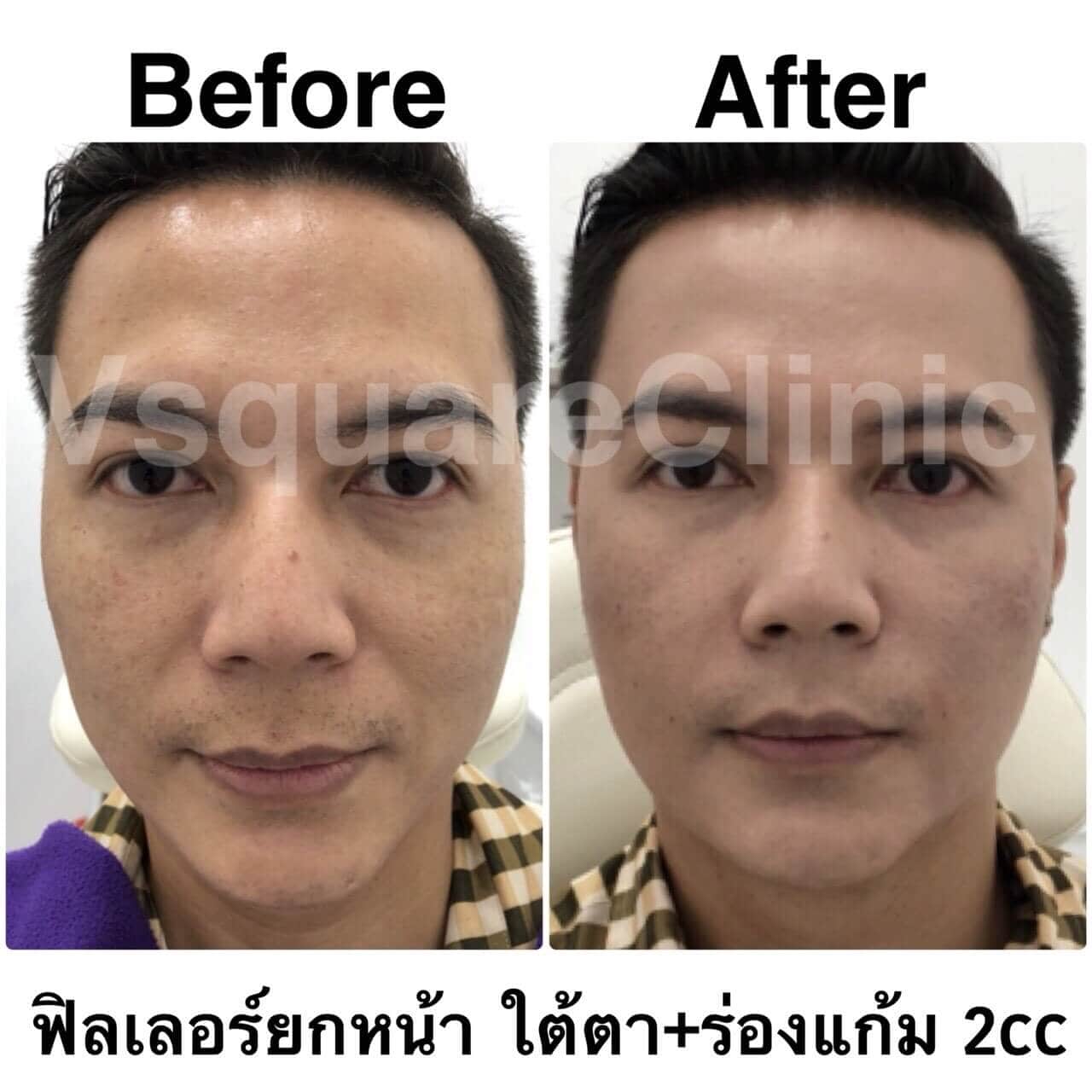 ตัวอย่างรีวิว ฟิลเลอร์ยกหน้า ใต้ตา+ร่องแก้ม 2 cc