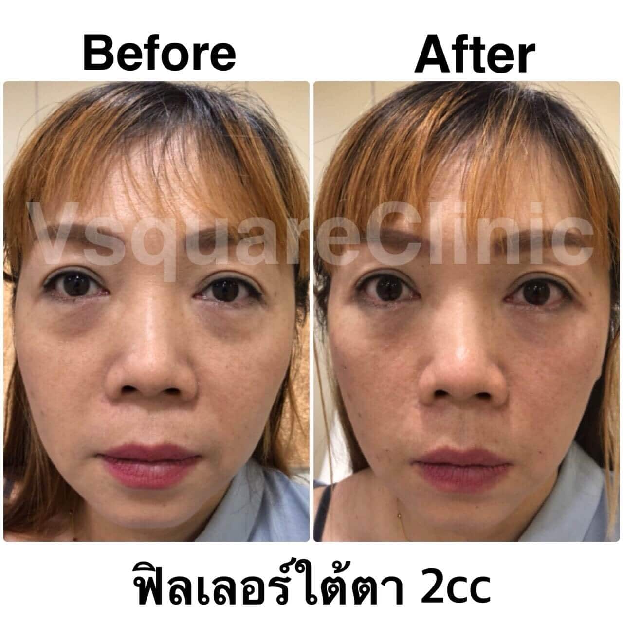 ตัวอย่างรีวิว ฟิลเลอร์ใต้ตา 2cc