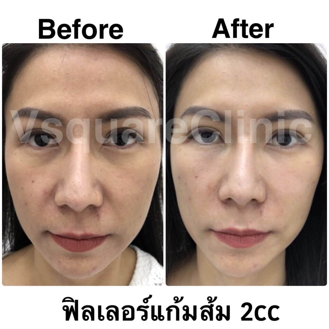 ตัวอย่างรีวิว ฟิลเลอร์แก้มส้ม 2cc