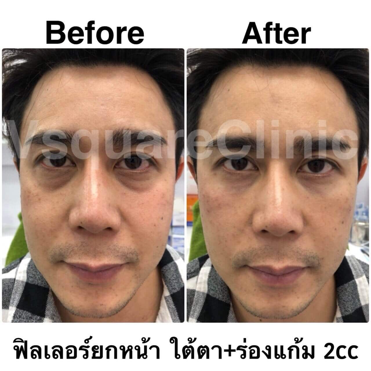 ตัวอย่างรีวิว ฟิลเลอร์ยกหน้า ใต้ตา+ร่องแก้ม 2cc