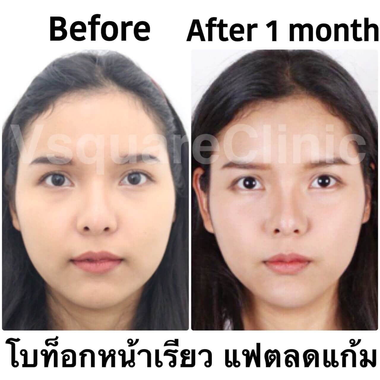 before after โบท็อกลดกราม