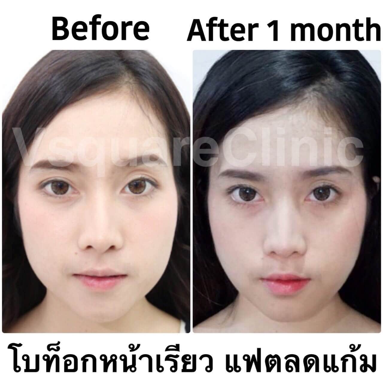 ตัวอย่างรีวิว โบท็อกหน้าเรียว แฟตลดแก้ม