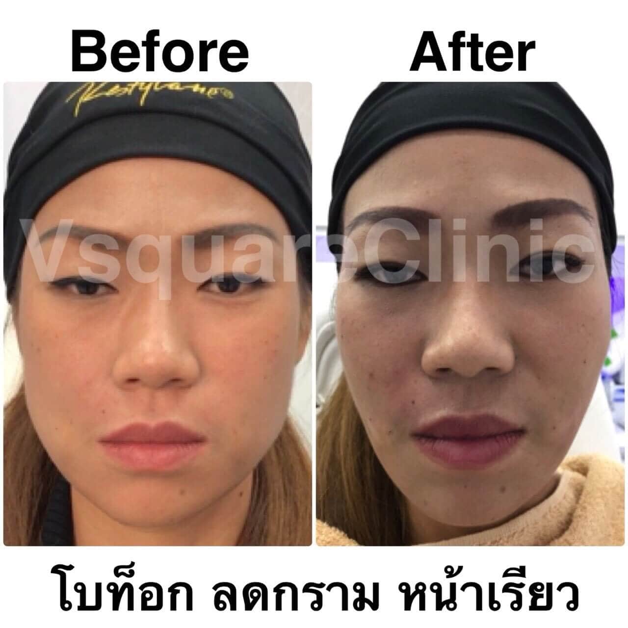 ตัวอย่างรีวิว โบท็อกลดกราม หน้าเรียว