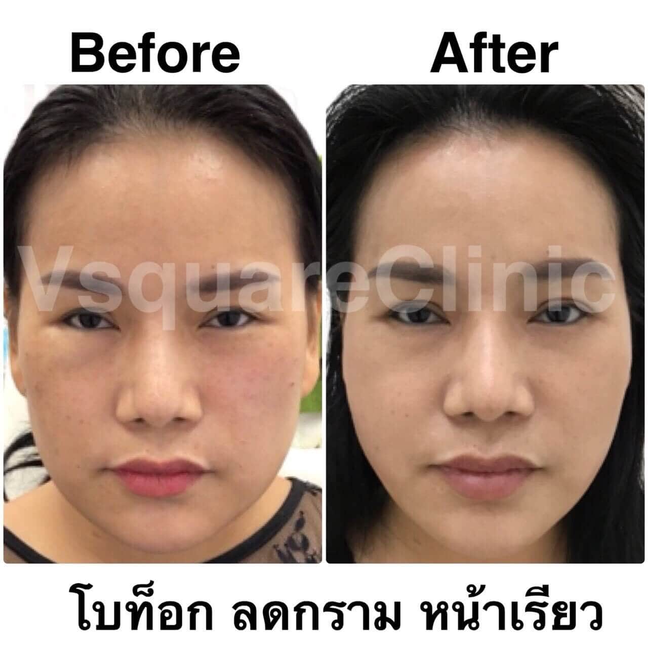 before after โบท็อกลดกราม