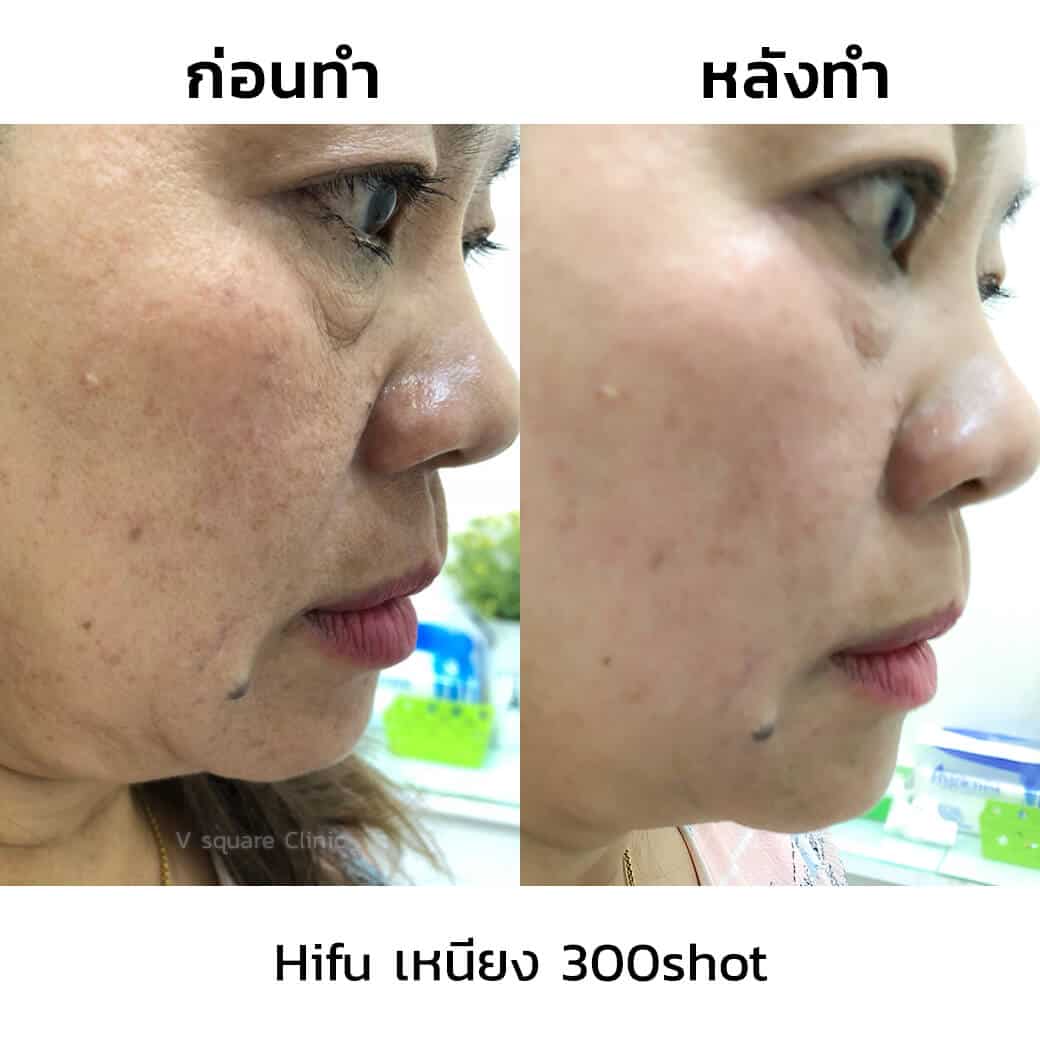 review-hifu-เหนียง-300shot review-hifu-เหนียง-300shot