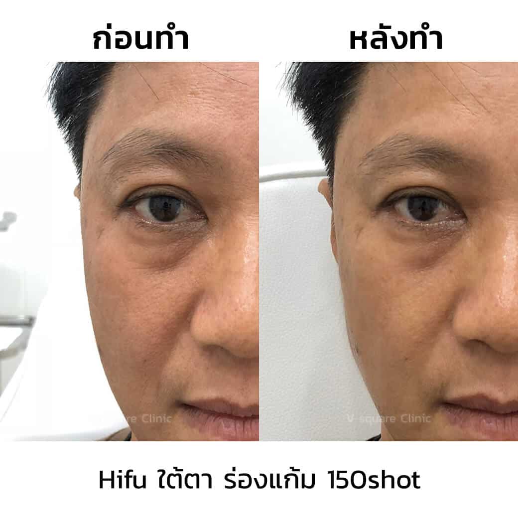 Hifu ที่ไหนดี แนะนำโดย V square clinic Hifu ที่ไหนดี แนะนำโดย V square clinic