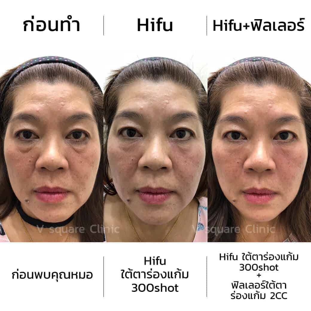 review-hifu-ใต้ตาร่องแก้ม-300shot-ฟิลเลอร์ใต้ตาร่องแก้ม