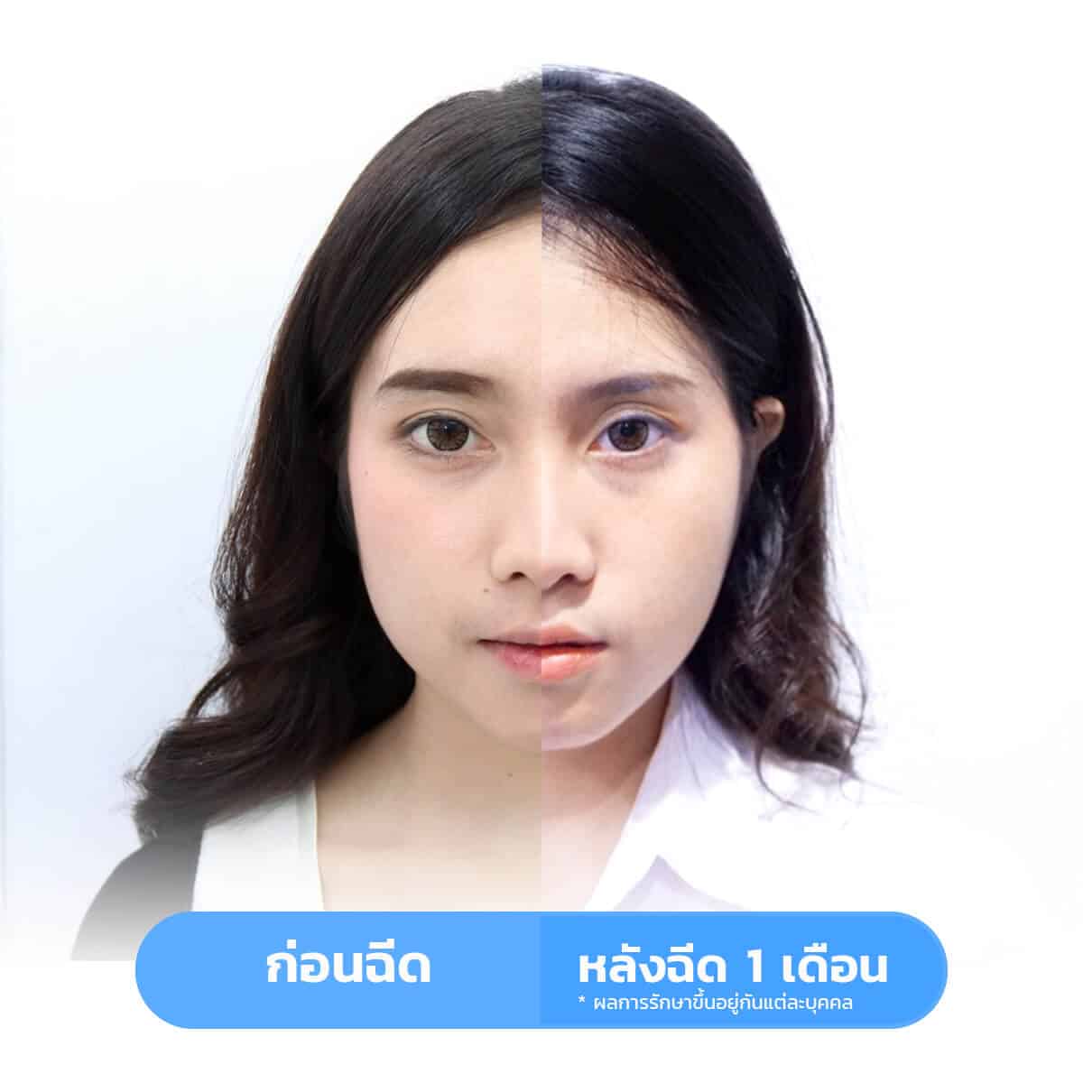 รีวิวหลังฉีดโบท็อกลดกราม 1 เดือน