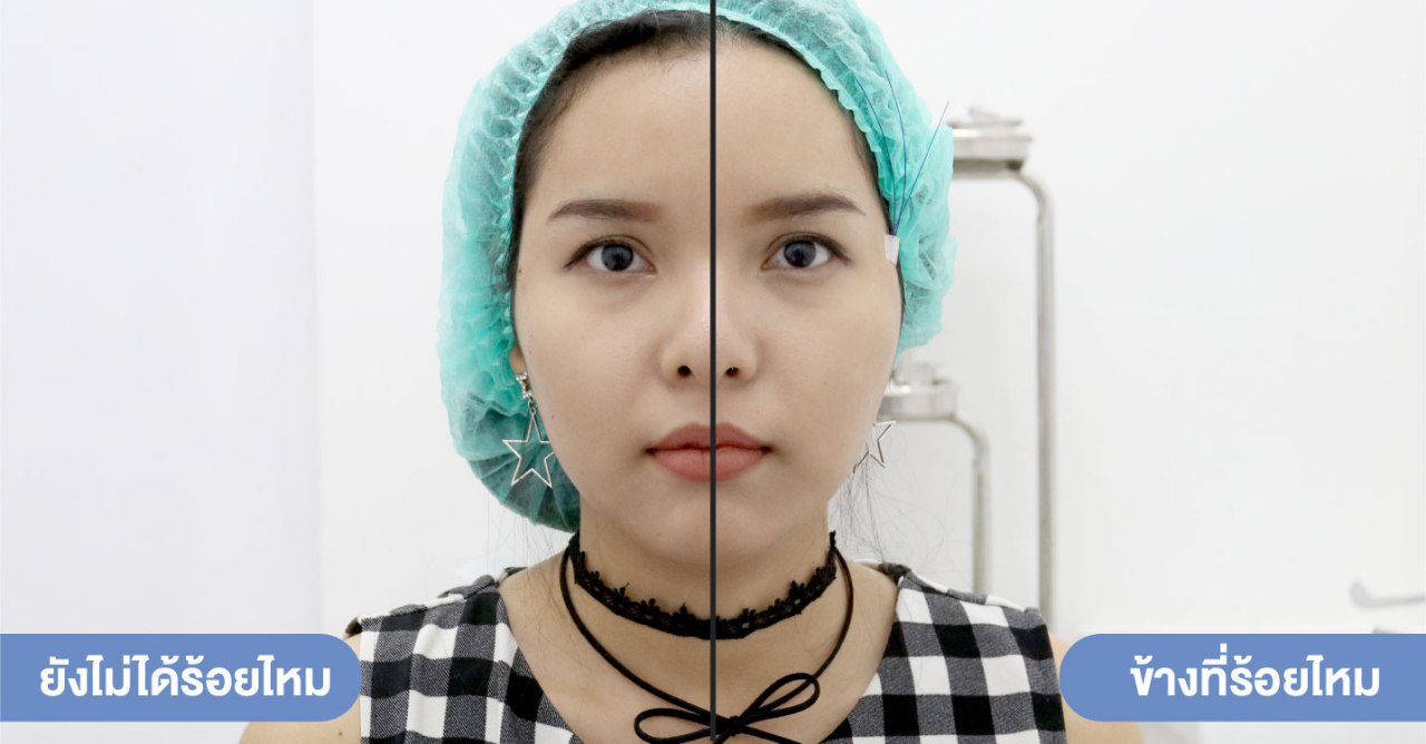 รีวิวร้อยไหม-before-after