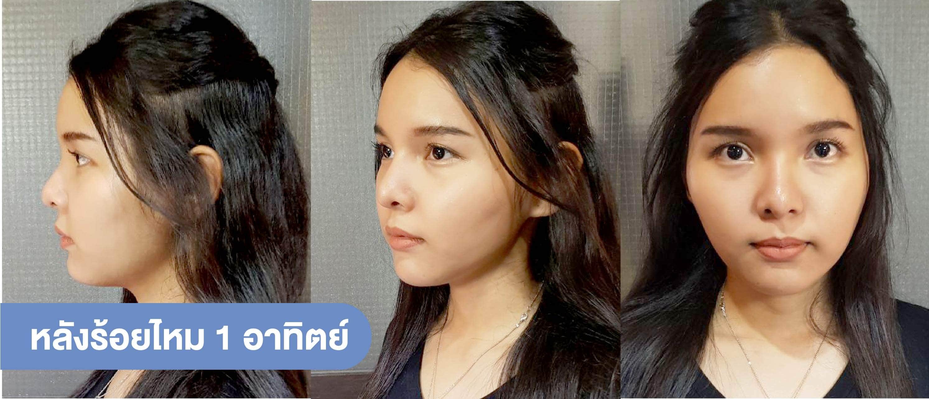 ร้อยไหม-9