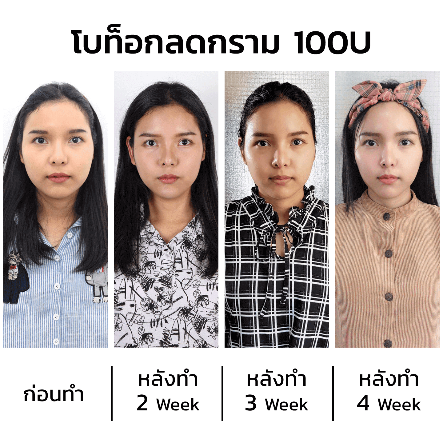 ฉีดโบลดกราม ที่ไหนดี