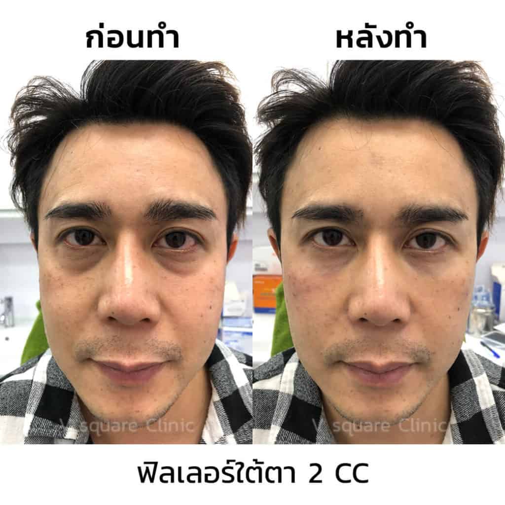 รีวิว ฟิลเลอร์ใต้ตา 2 CC