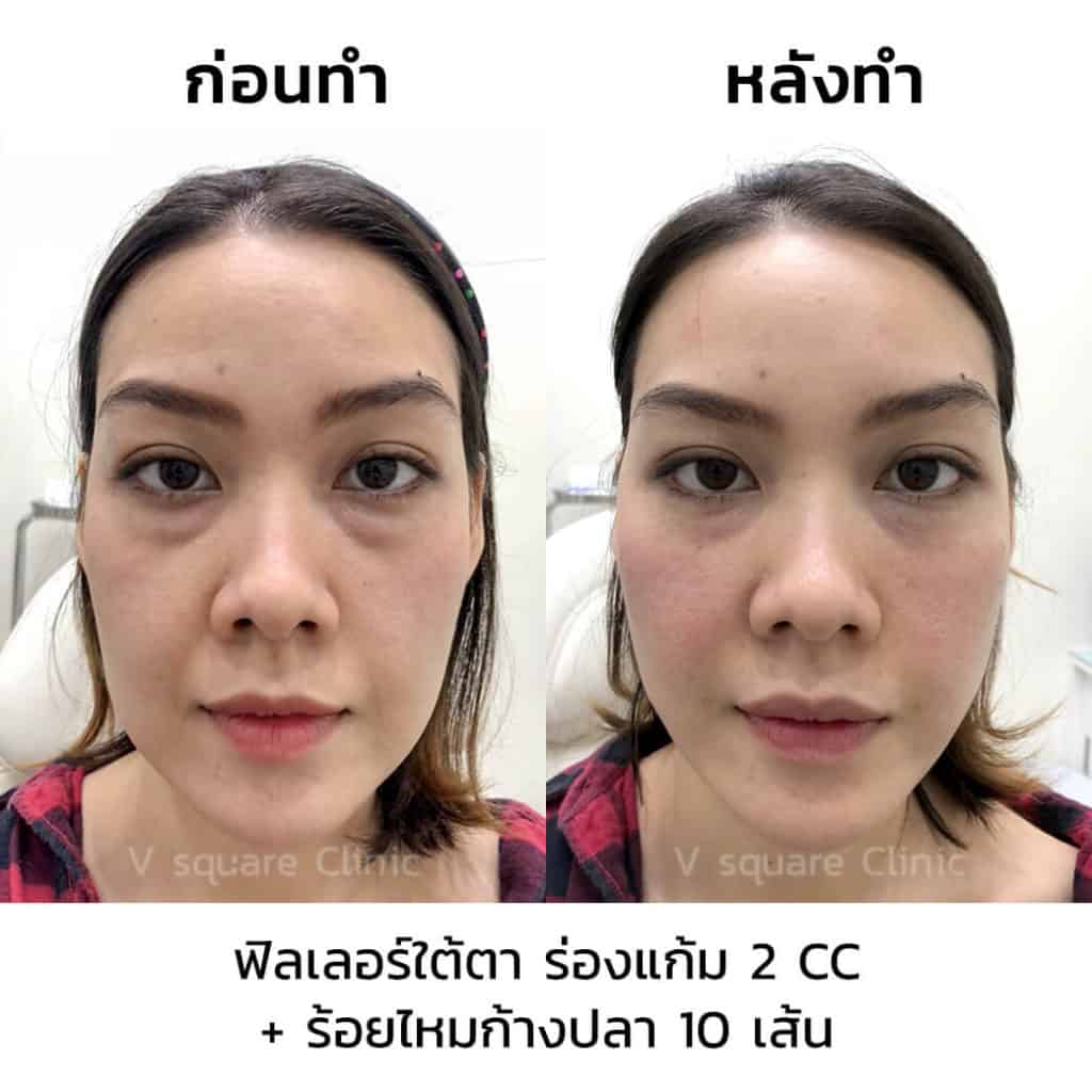 รีวิวร้อยไหมก้างปลา 10 เส้น+ฟิลเลอร์ใต้ตา 2 CC