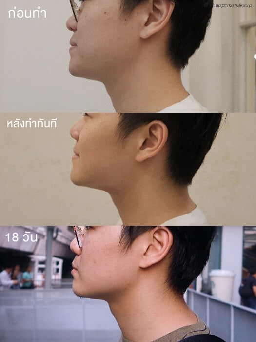 รีวิวผลการทำ Hifu (ผู้ชาย)