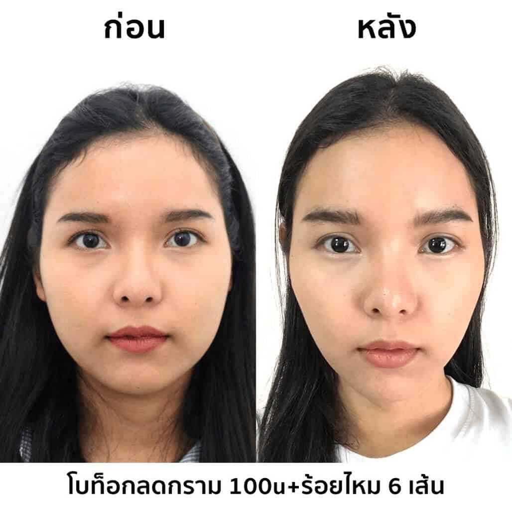 รีวิวฉีดเมโสแฟต ปรับหน้าเรียว ลดแก้มห้อย ดูเป็นธรรมชาติ ! [อัพเดท 2023]