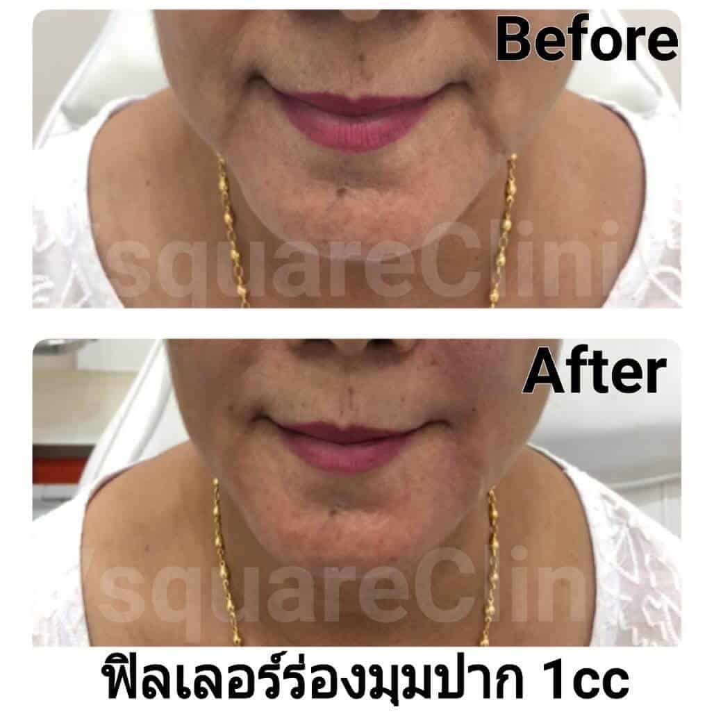 รีวิวฟิลเลอร์ร่องมุมปาก