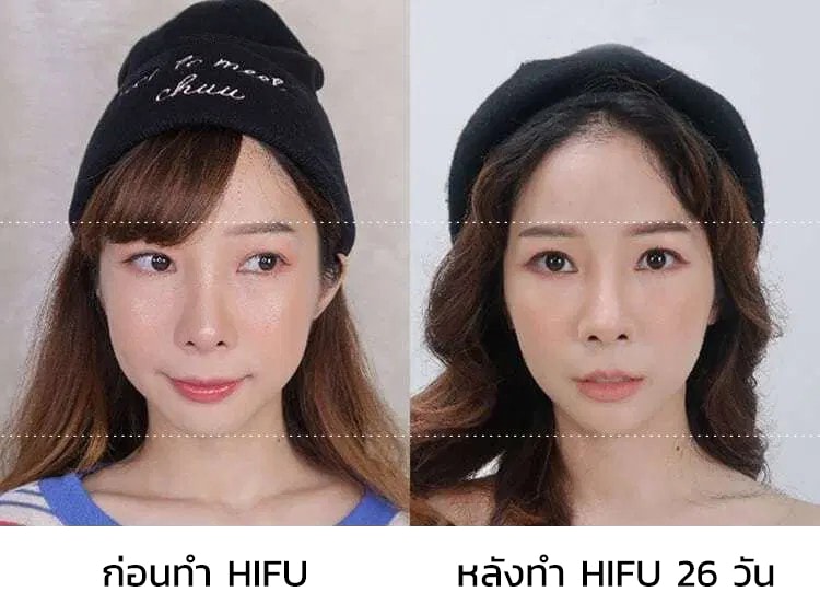 ภาพ Review Hifu ก่อนทำและหลังทำ