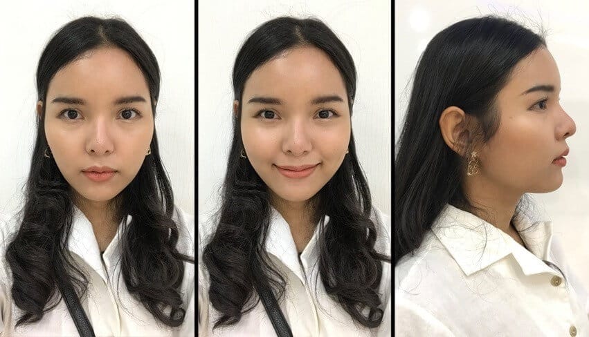 รีวิวฉีดเมโสแฟต ปรับหน้าเรียว ลดแก้มห้อย ดูเป็นธรรมชาติ ! [อัพเดท 2023]