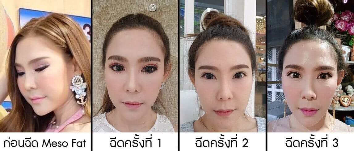 รูปภาพเปรียบเทียบก่อน-หลังฉีดเมโสแฟตแต่ละสัปดาห์