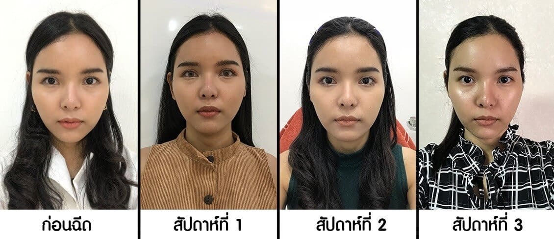 ผลสรุปจากการฉีดเมโสแฟตสลายไขมันใน