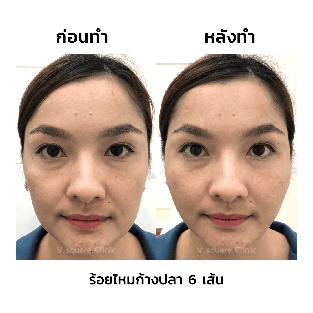 [ โปรร้อยไหม ราคา พิเศษลด 50 ] ปรับรูปหน้าเรียวสวย จาก V Square Clinic