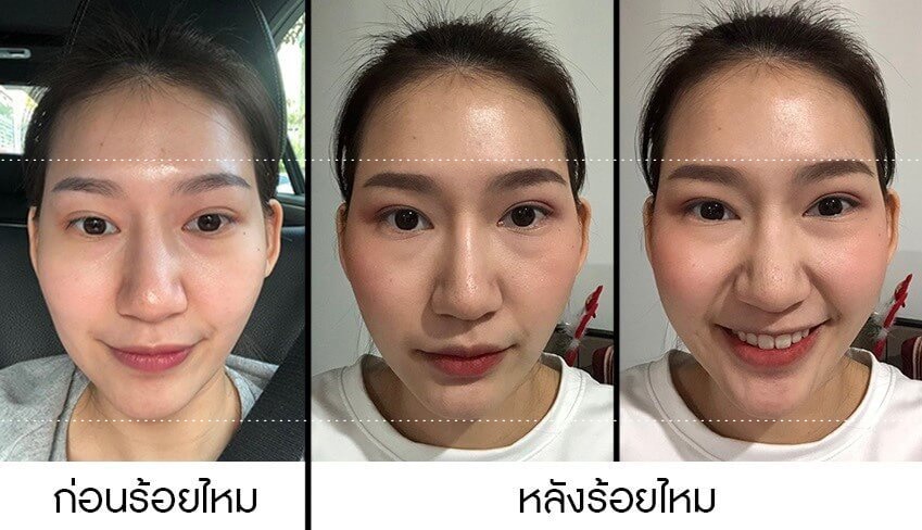 รีวิวปรับรูปหน้าแก้ปัญหา หน้าไม่เท่ากัน ด้วยฟิลเลอร์ เมโสแฟตและร้อยไหม รีวิวปรับรูปหน้าแก้ปัญหา หน้าไม่เท่ากัน ด้วยฟิลเลอร์ เมโสแฟตและร้อยไหม