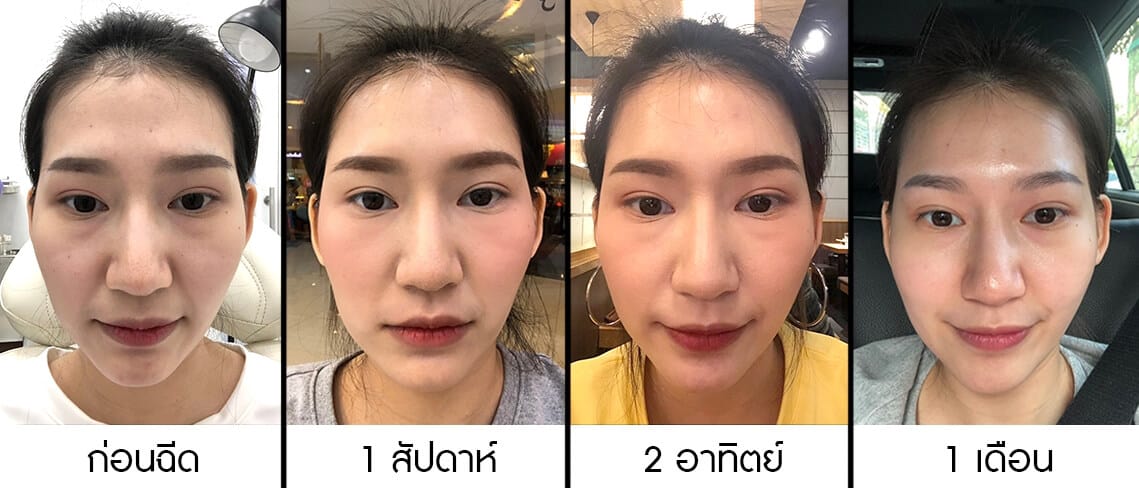 รูปภาพก่อน-หลังเปรียบเทียบการแก้ปัญหา หน้าไม่เท่ากัน