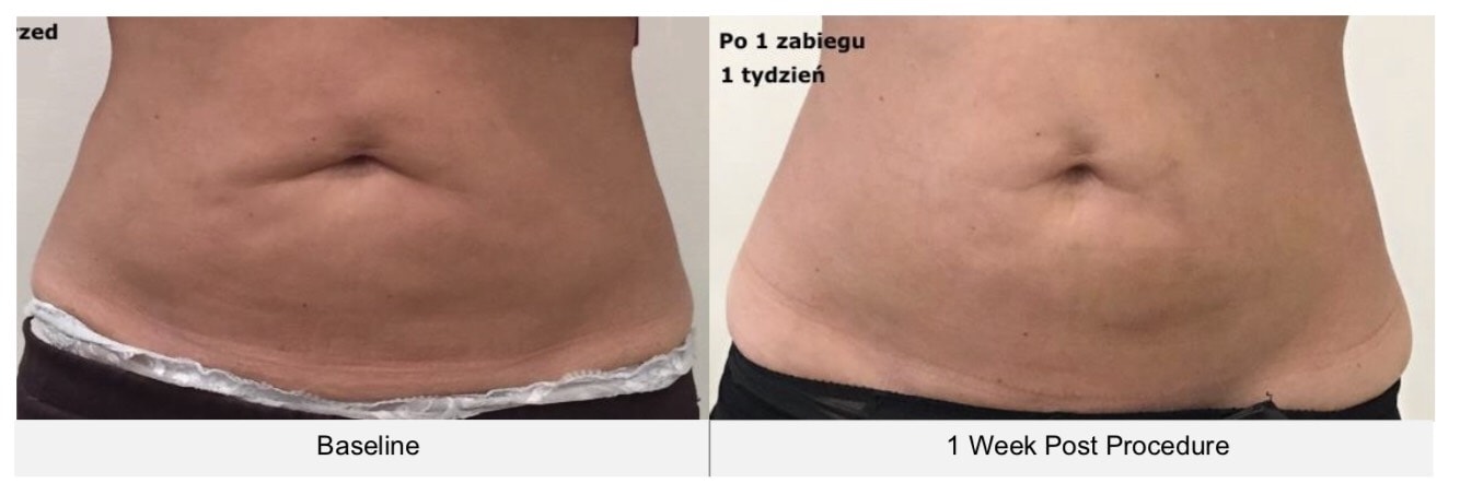 ตัวอย่างรีวิวผลการรักษา cellulite บริเวณหน้าท้องด้วยเครื่อง Ultraformer III-2