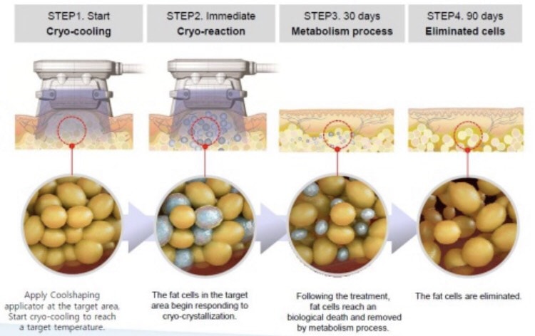 ตัวอย่างการทำงานของเครื่อง เครื่อง Coolsculpting