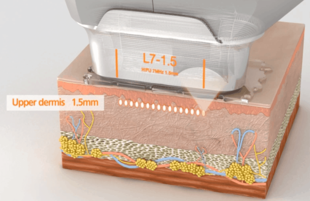 hifu-ความลึก-1.5-2.0-mm