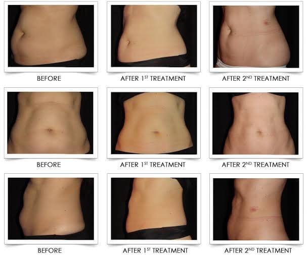 ตัวอย่างรีวิวผลการรักษาด้วยเครื่อง CoolSculpting