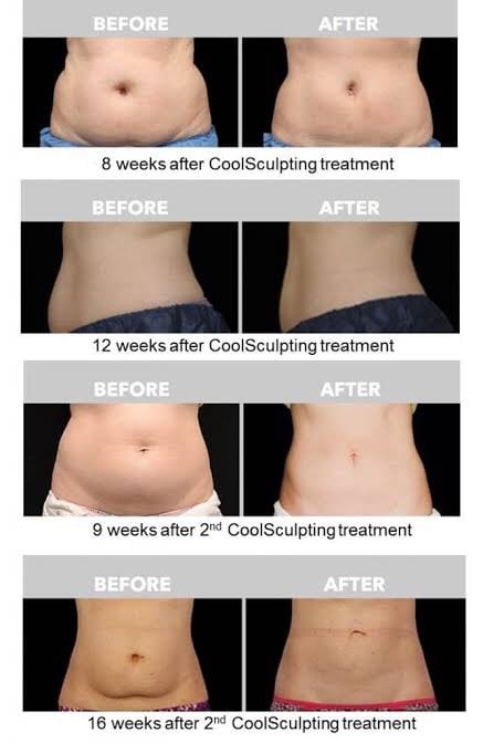 ตัวอย่างรีวิวผลการรักษาด้วยเครื่อง CoolSculpting