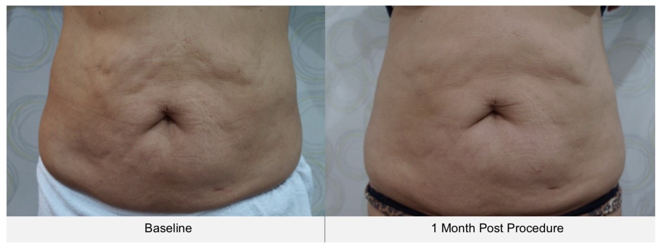 ตัวอย่างรีวิวผลการรักษา cellulite บริเวณหน้าท้องด้วยเครื่อง Ultraformer III