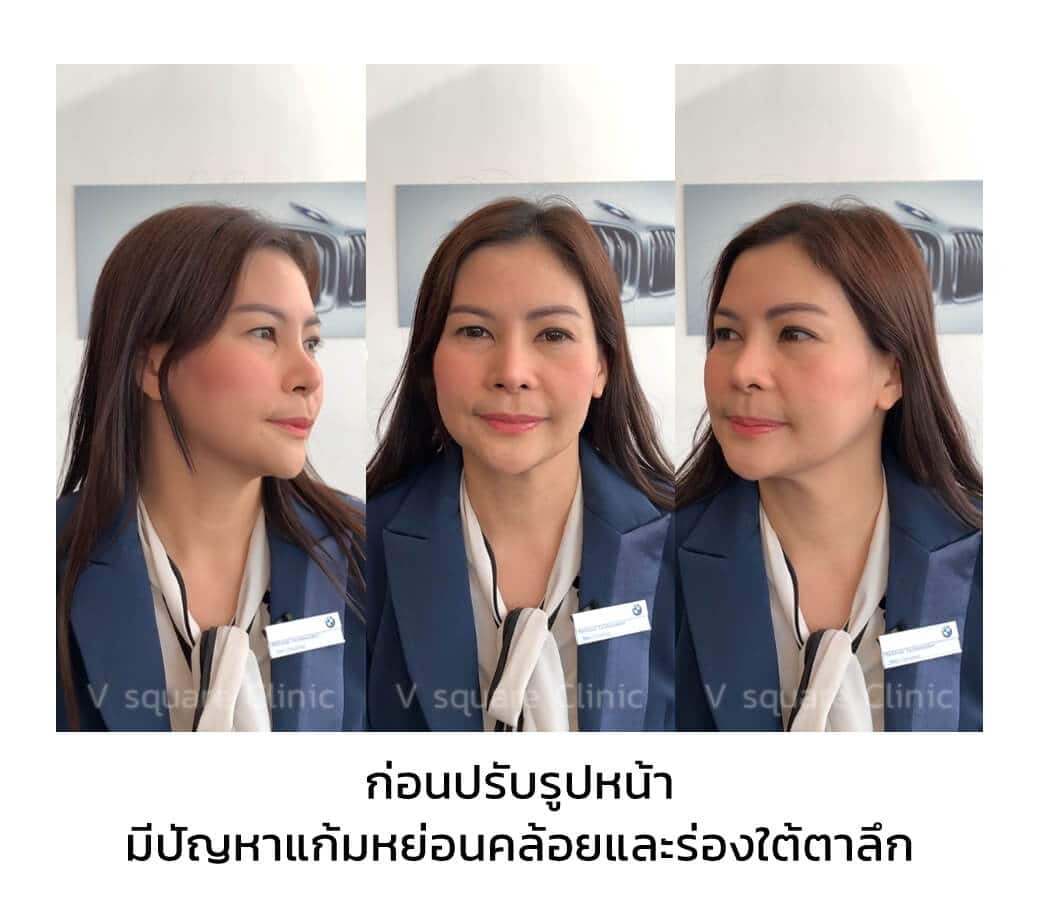 ก่อนเข้ามารักษาคนไข้มีปัญหา แก้มหย่อนคล้อย และ ร่องใต้ตาลึก