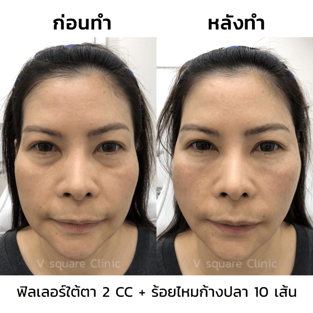 รีวิวฉีดฟิลเลอร์ใต้ตา 2 CC + ร้อยไหมก้างปลา 10 เส้น