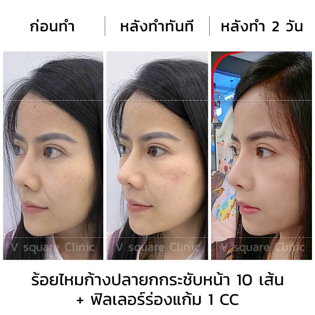 ร้อยไหมก้างปลายกกระชับหน้า10เส้นและเติมฟิลเลอร์ร่องแก้ม1CC_ด้านข้าง