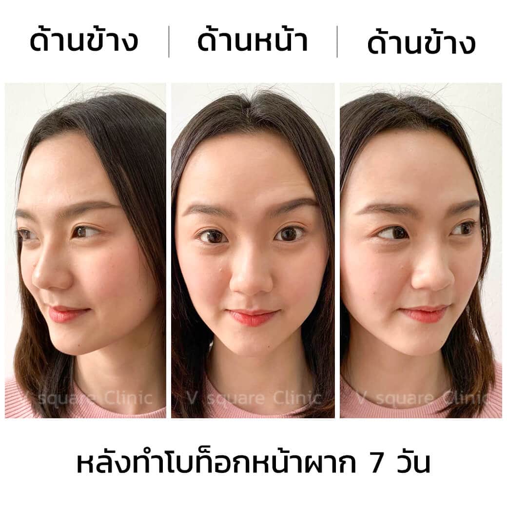 หลังทำโบท็อกหน้าผาก7วัน_3ช่อง