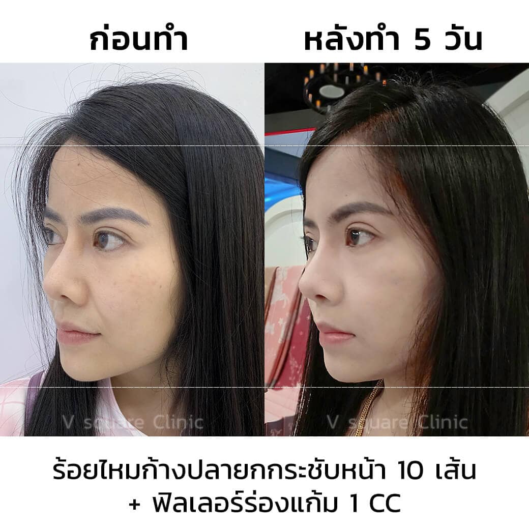 ร้อยไหมก้างปลายกกระชับหน้า10เส้นและเติมฟิลเลอร์ร่องแก้ม1CC_5วัน_ด้านข้าง