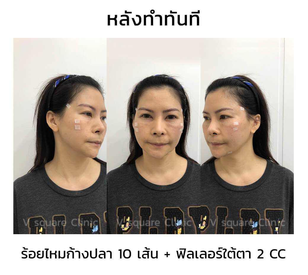 รีวิวผลการฉีดฟิลเลอร์ใต้ตา