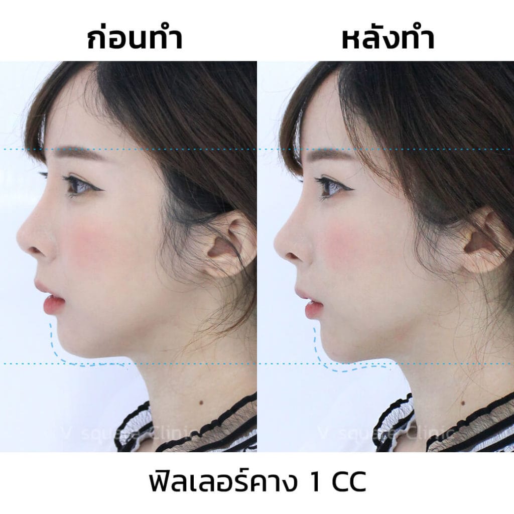 ฟิลเลอร์คาง-1-CC_ด้านข้าง