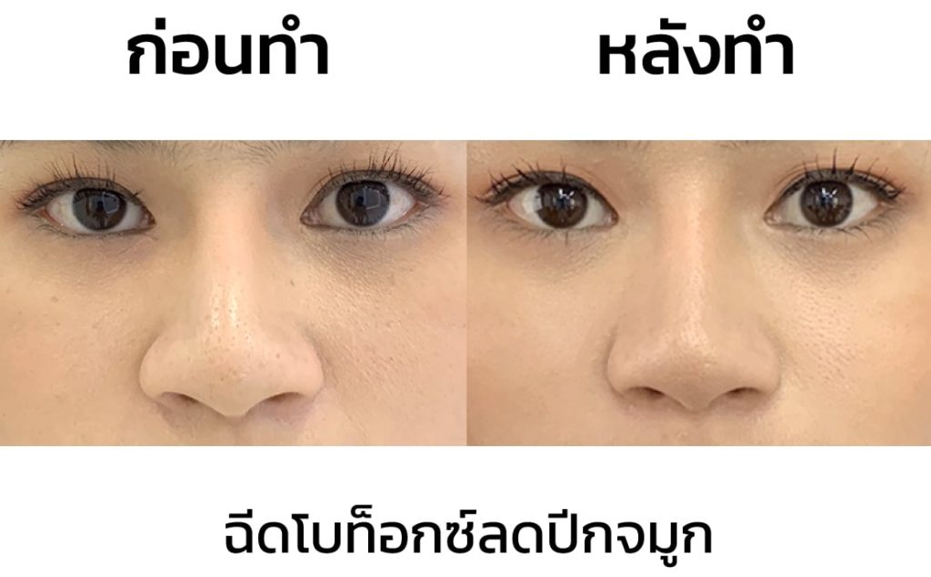 รีวิว โบท็อกปีกจมูก