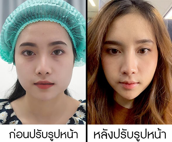 รีวิวฉีดเมโสแฟต